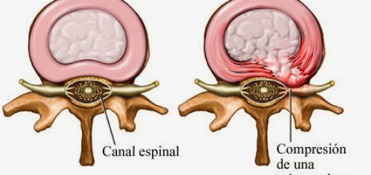 Hernia discal, la lesión insignia del trial